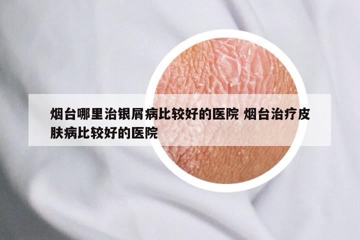 烟台哪里治银屑病比较好的医院 烟台治疗皮肤病比较好的医院