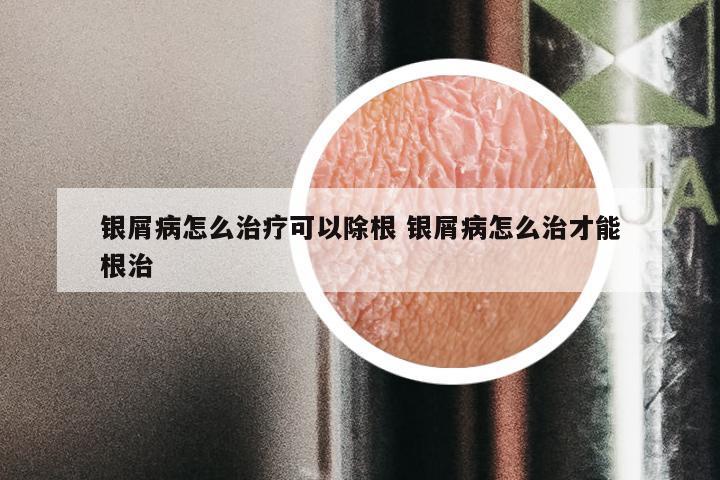 银屑病怎么治疗可以除根 银屑病怎么治才能根治