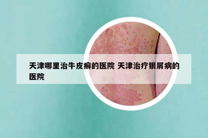 天津哪里治牛皮癣的医院 天津治疗银屑病的医院