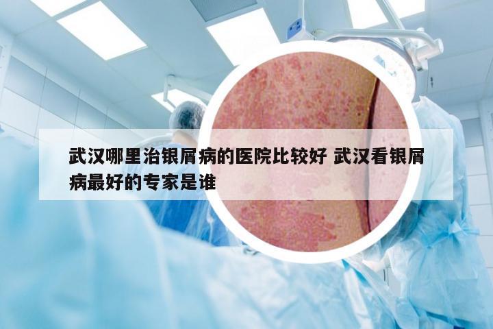 武汉哪里治银屑病的医院比较好 武汉看银屑病最好的专家是谁