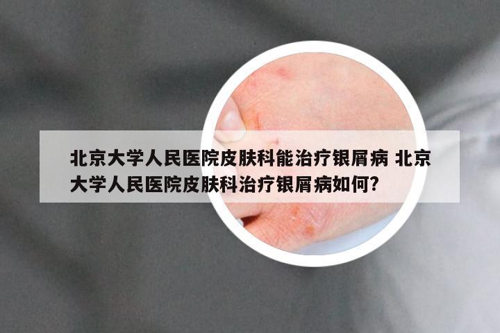 北京大学人民医院皮肤科能治疗银屑病 北京大学人民医院皮肤科治疗银屑病如何?