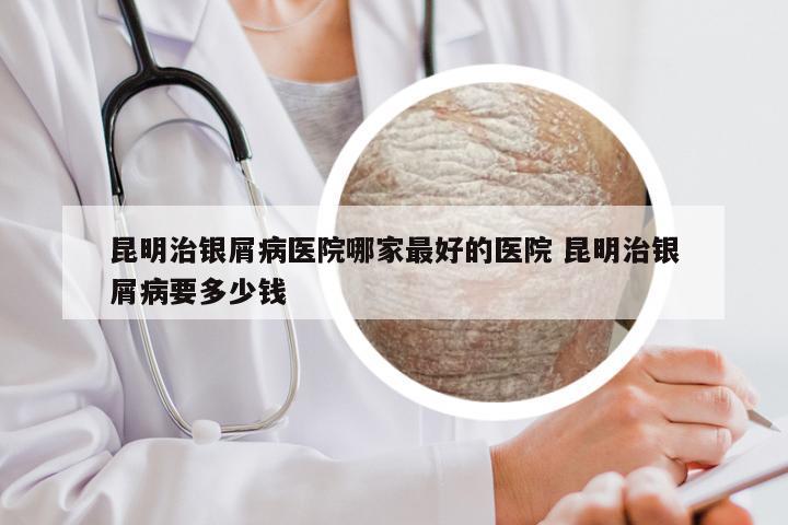 昆明治银屑病医院哪家最好的医院 昆明治银屑病要多少钱