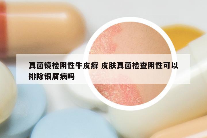 真菌镜检阴性牛皮癣 皮肤真菌检查阴性可以排除银屑病吗