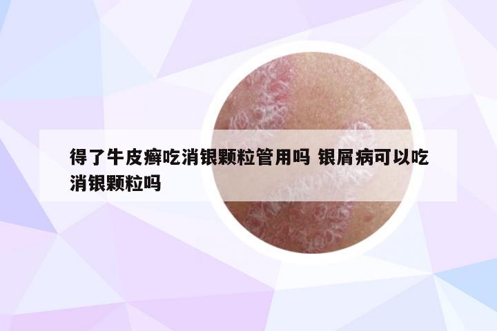 得了牛皮癣吃消银颗粒管用吗 银屑病可以吃消银颗粒吗