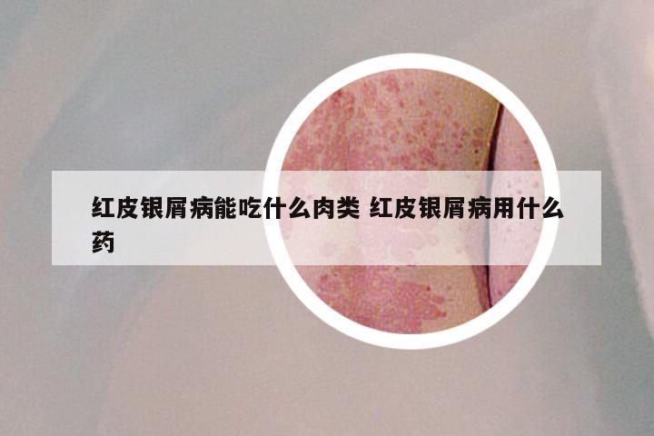 红皮银屑病能吃什么肉类 红皮银屑病用什么药