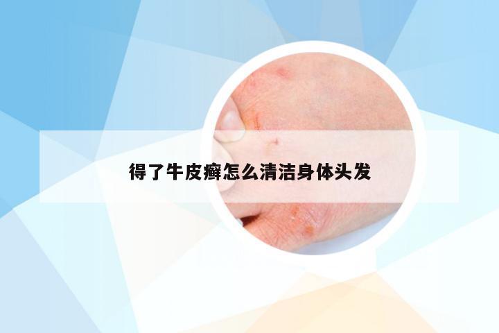 得了牛皮癣怎么清洁身体头发