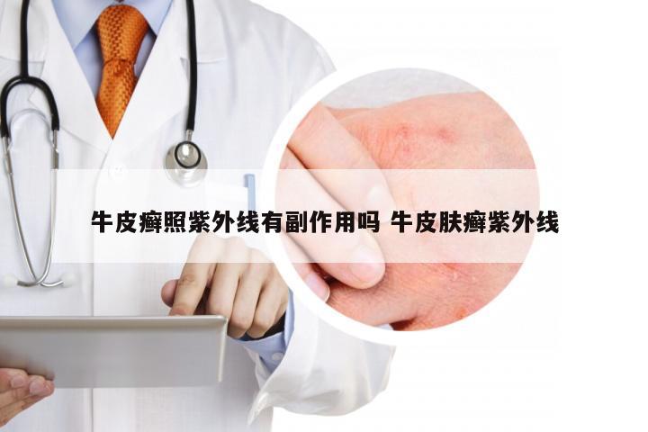 牛皮癣照紫外线有副作用吗 牛皮肤癣紫外线