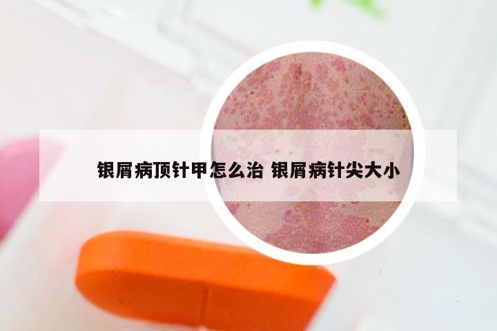 银屑病顶针甲怎么治 银屑病针尖大小