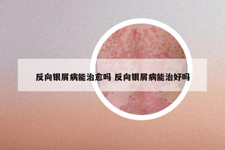 反向银屑病能治愈吗 反向银屑病能治好吗
