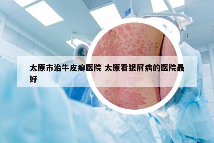 太原市治牛皮癣医院 太原看银屑病的医院最好
