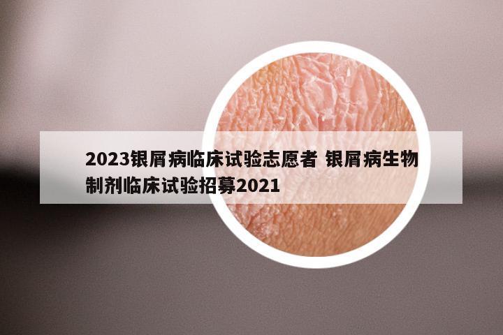 2023银屑病临床试验志愿者 银屑病生物制剂临床试验招募2021