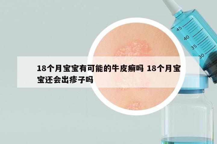 18个月宝宝有可能的牛皮癣吗 18个月宝宝还会出疹子吗