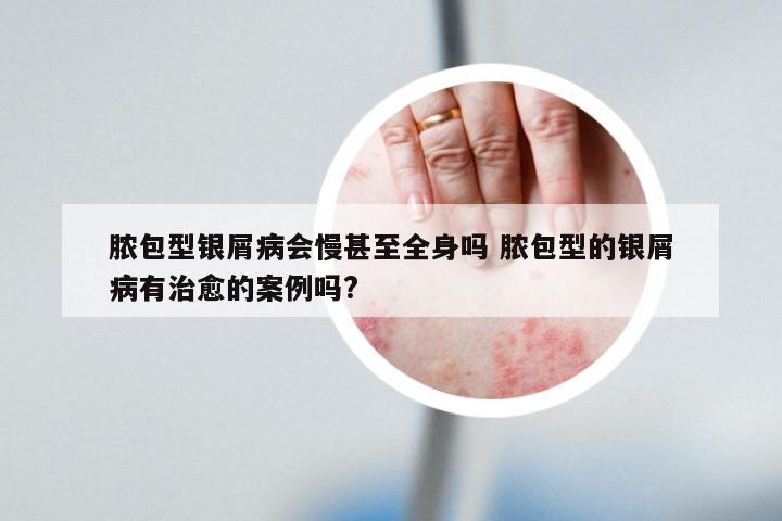 脓包型银屑病会慢甚至全身吗 脓包型的银屑病有治愈的案例吗?