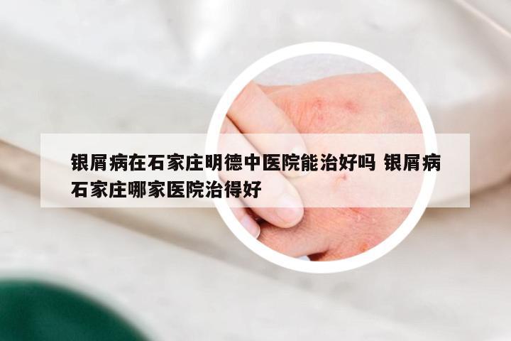 银屑病在石家庄明德中医院能治好吗 银屑病石家庄哪家医院治得好