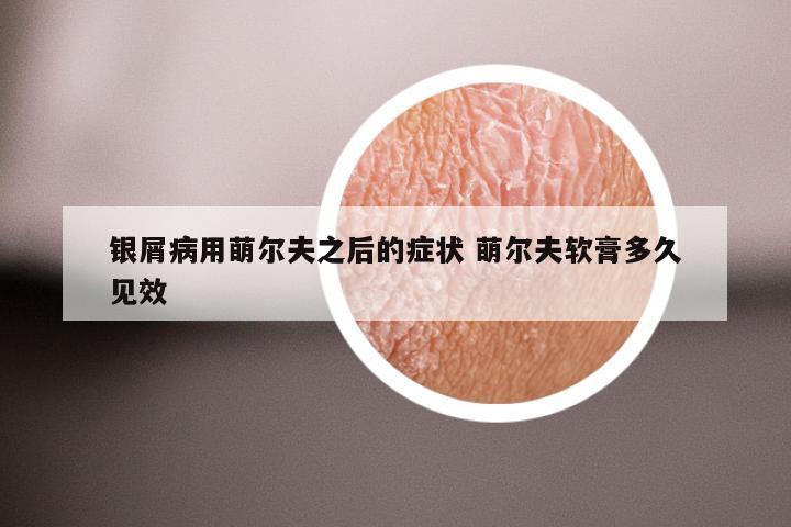 银屑病用萌尔夫之后的症状 萌尔夫软膏多久见效