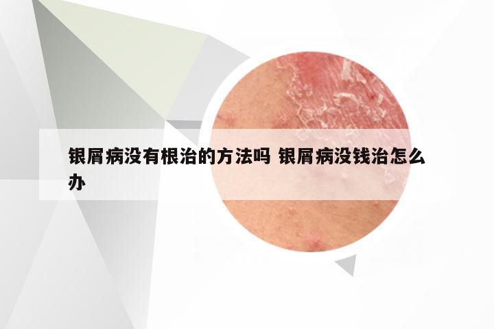 银屑病没有根治的方法吗 银屑病没钱治怎么办