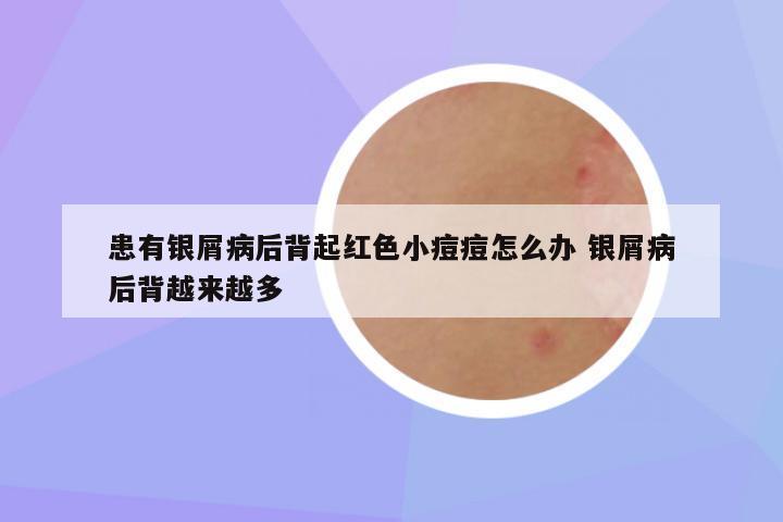 患有银屑病后背起红色小痘痘怎么办 银屑病后背越来越多