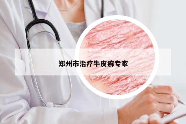郑州市治疗牛皮癣专家
