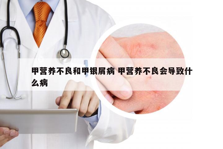 甲营养不良和甲银屑病 甲营养不良会导致什么病