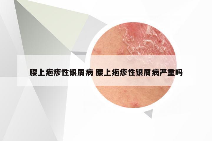 腰上疱疹性银屑病 腰上疱疹性银屑病严重吗