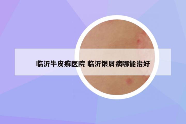 临沂牛皮癣医院 临沂银屑病哪能治好
