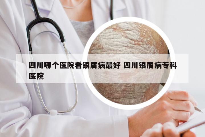 四川哪个医院看银屑病最好 四川银屑病专科医院
