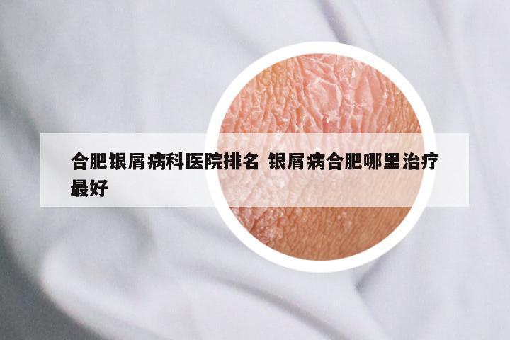 合肥银屑病科医院排名 银屑病合肥哪里治疗最好