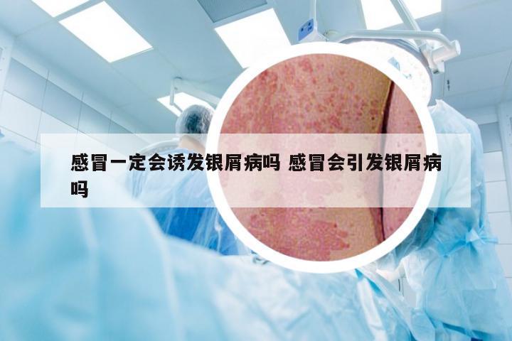 感冒一定会诱发银屑病吗 感冒会引发银屑病吗