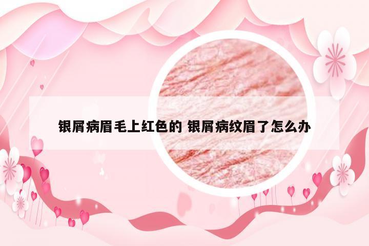 银屑病眉毛上红色的 银屑病纹眉了怎么办