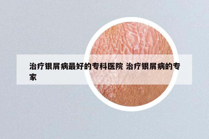 治疗银屑病最好的专科医院 治疗银屑病的专家