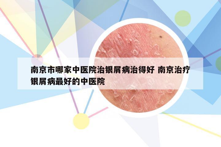 南京市哪家中医院治银屑病治得好 南京治疗银屑病最好的中医院