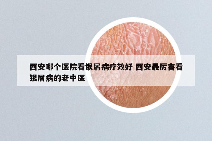 西安哪个医院看银屑病疗效好 西安最厉害看银屑病的老中医
