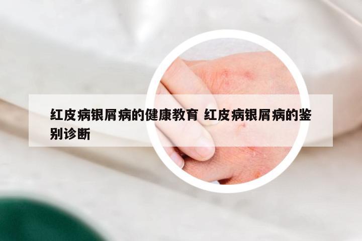 红皮病银屑病的健康教育 红皮病银屑病的鉴别诊断