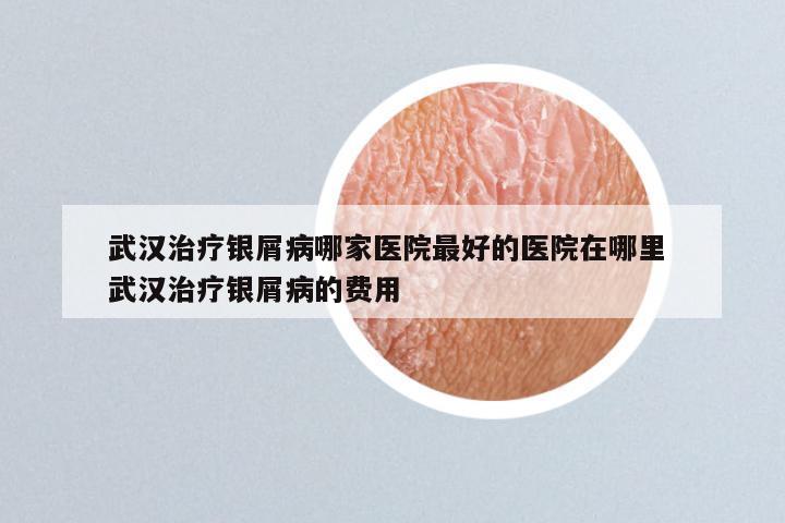 武汉治疗银屑病哪家医院最好的医院在哪里 武汉治疗银屑病的费用