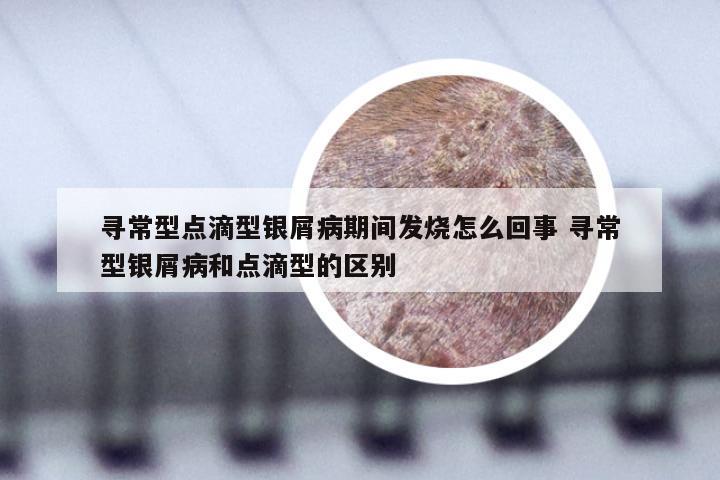 寻常型点滴型银屑病期间发烧怎么回事 寻常型银屑病和点滴型的区别