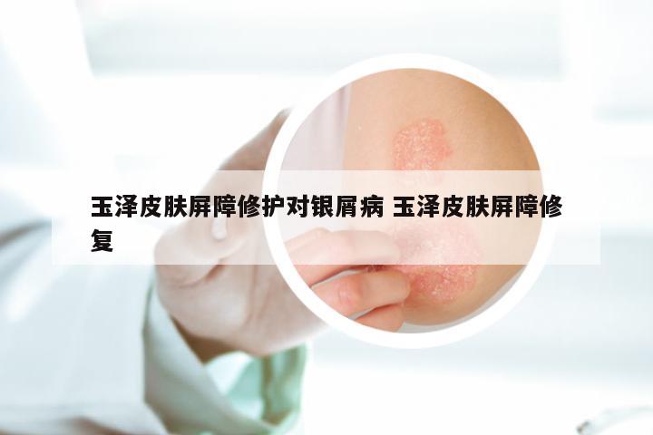 玉泽皮肤屏障修护对银屑病 玉泽皮肤屏障修复