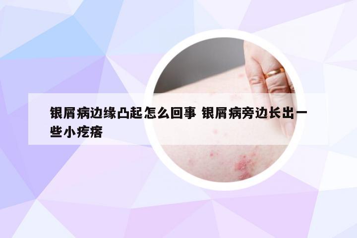 银屑病边缘凸起怎么回事 银屑病旁边长出一些小疙瘩