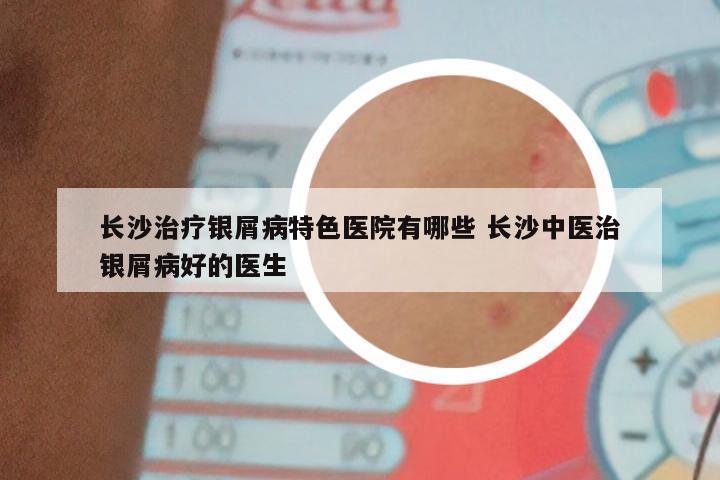 长沙治疗银屑病特色医院有哪些 长沙中医治银屑病好的医生
