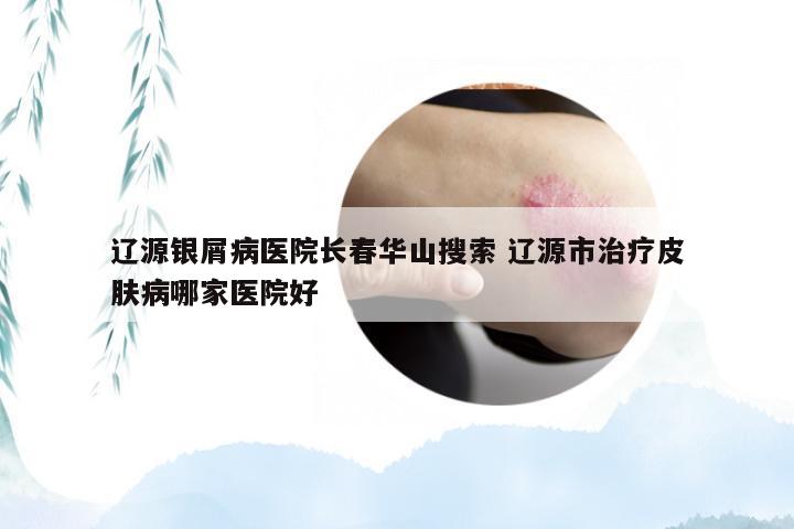 辽源银屑病医院长春华山搜索 辽源市治疗皮肤病哪家医院好