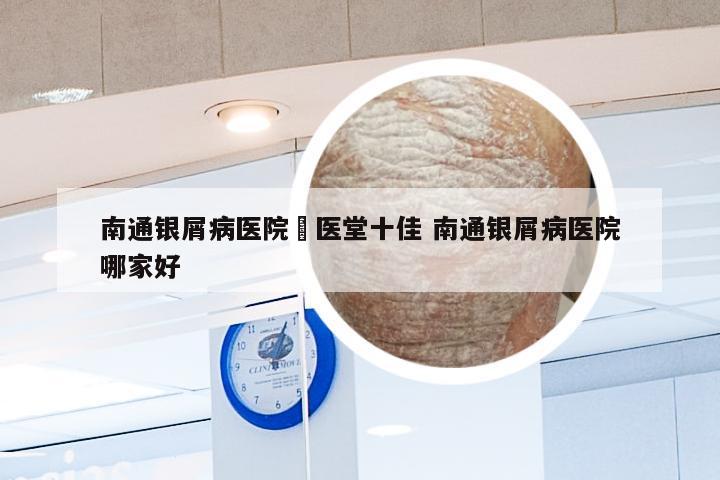 南通银屑病医院崋医堂十佳 南通银屑病医院哪家好
