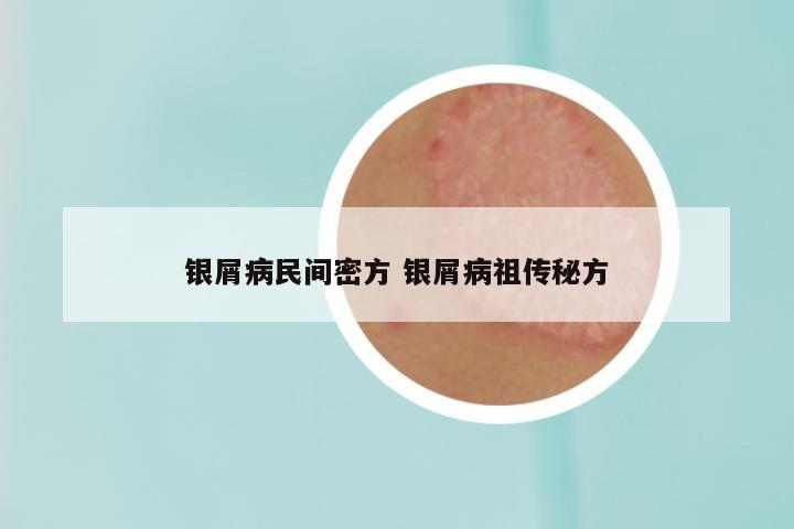 银屑病民间密方 银屑病祖传秘方