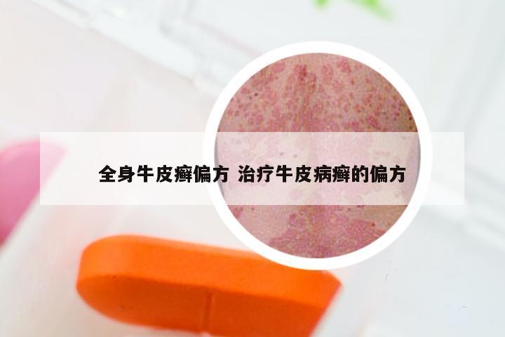 全身牛皮癣偏方 治疗牛皮病癣的偏方