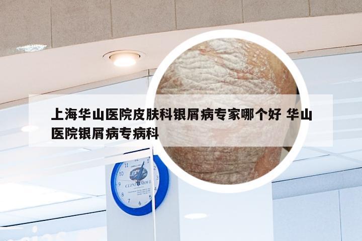 上海华山医院皮肤科银屑病专家哪个好 华山医院银屑病专病科
