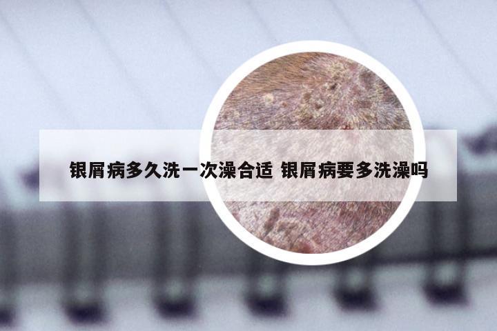 银屑病多久洗一次澡合适 银屑病要多洗澡吗