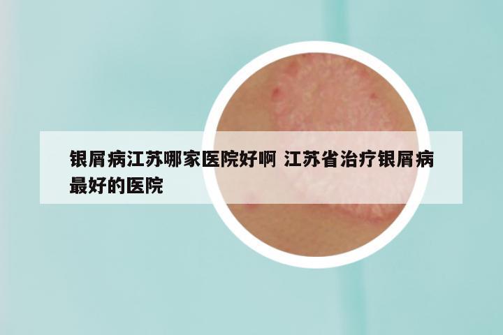 银屑病江苏哪家医院好啊 江苏省治疗银屑病最好的医院