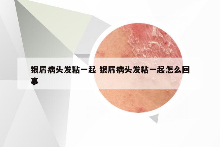 银屑病头发粘一起 银屑病头发粘一起怎么回事