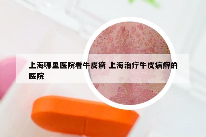 上海哪里医院看牛皮癣 上海治疗牛皮病癣的医院