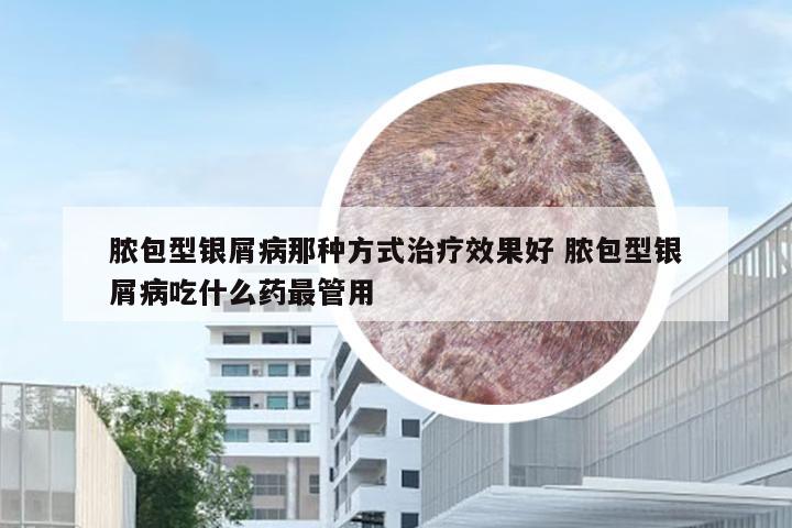 脓包型银屑病那种方式治疗效果好 脓包型银屑病吃什么药最管用