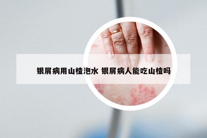 银屑病用山楂泡水 银屑病人能吃山楂吗