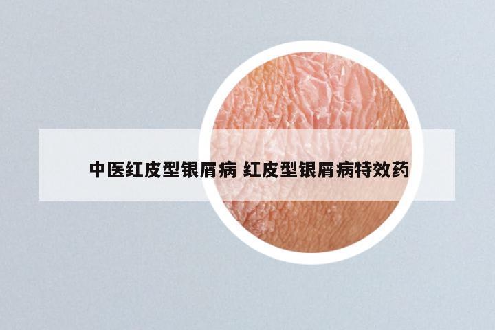 中医红皮型银屑病 红皮型银屑病特效药